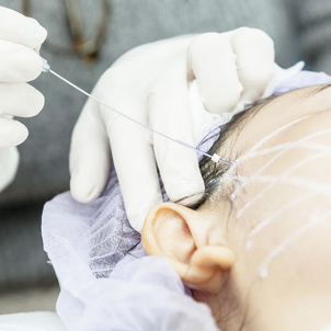 Co je to facelift (rhytidektomie) - operace obličeje