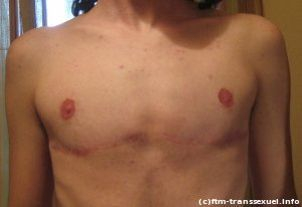 Bilaterální masektomie