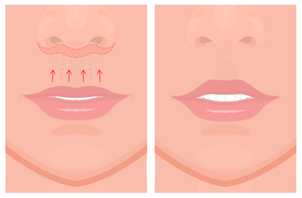 Schéma provedení lip liftu