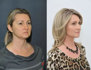 Fotky před a po niťovém liftingu (foto: soukromý archiv kliniky)