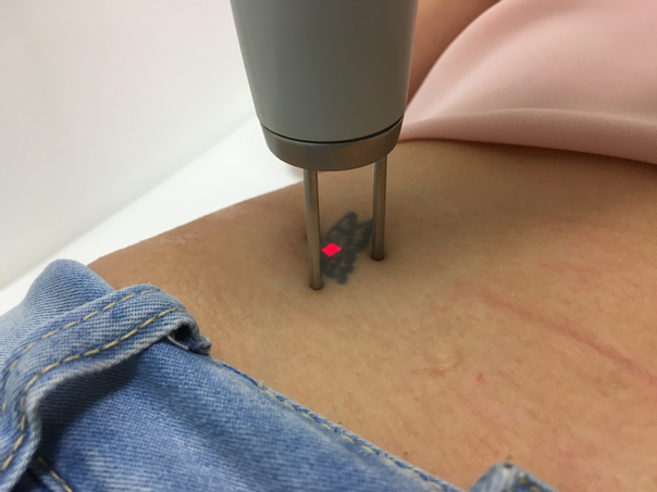 Nejběžnější lasery pro odstranění tetování