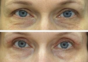 operace očních víček