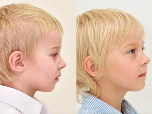 Jak probíhá zotavení po odstranění jizev laserem?