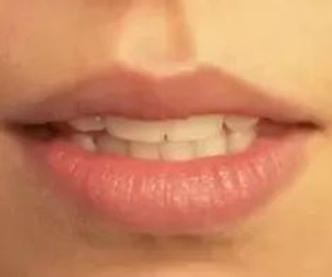 Jste vhodným kandidátem pro operaci rtů?