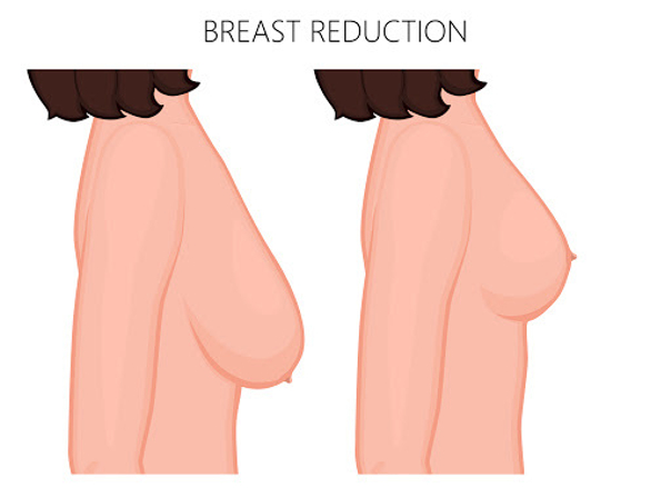 zmenšení prsou