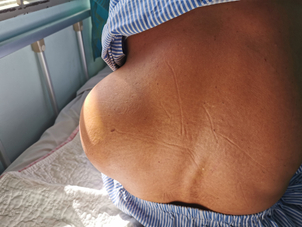 Výsledky odstranění lipomu