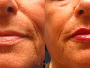 Mikropigmentace rtů