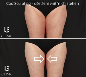 Výsledek kryolipolýzy