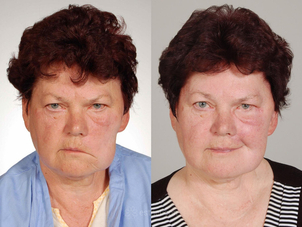 Výsledek zákroku v obličeji