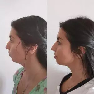 Výsledky injekční lipolýzy