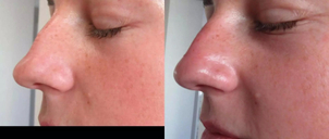 Nechirurgická korekce nosu