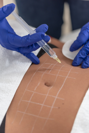 Co je injekční lipolýza?