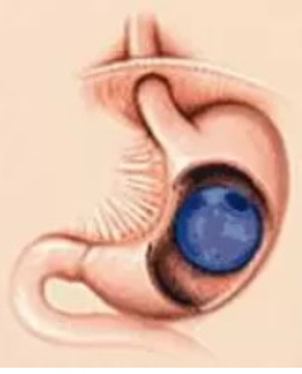 Intragastrický balon