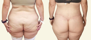 Před/po: gluteoplastika