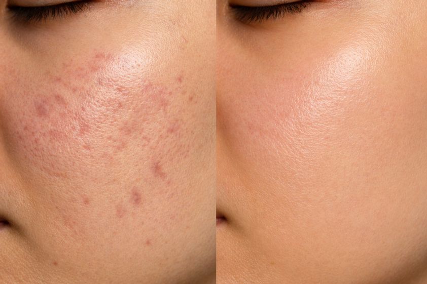 Laserová dermatologie