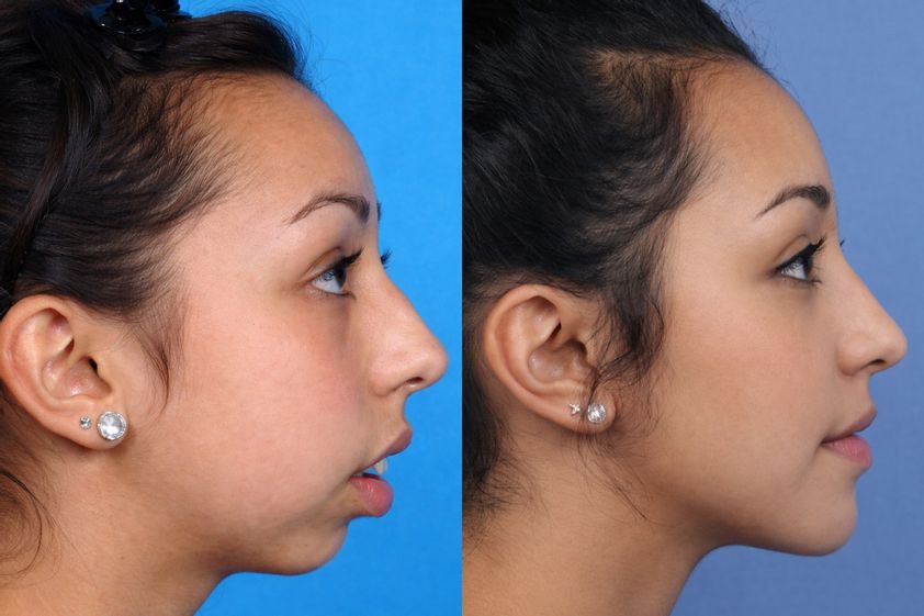 Profiloplastika