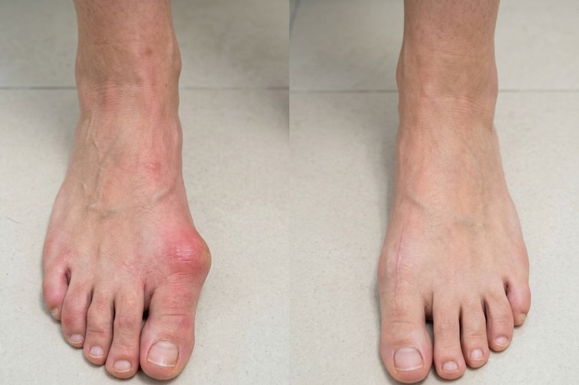 Hallux valgus