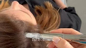 Estheticon_Vlasový microneedling