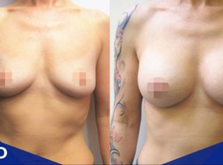 Výsledek zvětšení prsů u MUDr. Krejči, Laser Esthetic