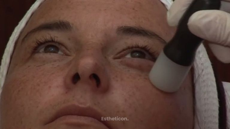 Revitalizace obličeje 2. část - Mezoterapie
