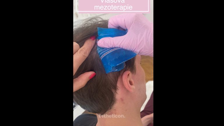 Vlasová Mezoterapie - Forever You Medical Center 