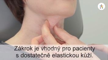 Jak probíhá odstranění podbradku metodou Belkyra