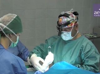 Operace obličeje MACS-lift na klinice Aestea