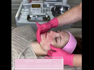 Lecba akne - kombinovane osetreni chemicky peeling + microneedling - Forever You Medical Center