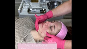 Lecba akne - kombinovane osetreni chemicky peeling + microneedling - Forever You Medical Center