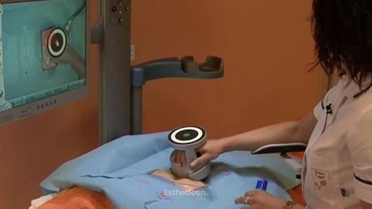 Ukázka ošetření UltraShape v kosmetickém salónu France Laure Cosmétiques
