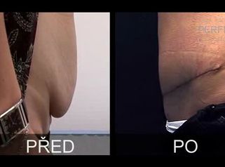 6 týdnů po abdominoplastice - MUDr. Zdeněk Pros
