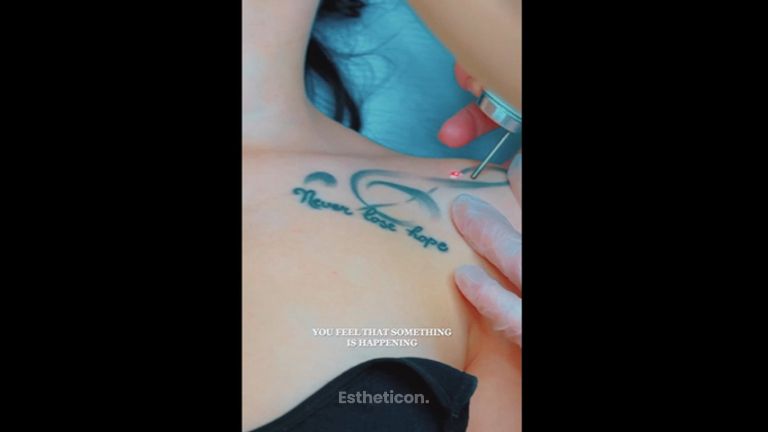 Odstranění tetování - Klinika Laser Esthetic