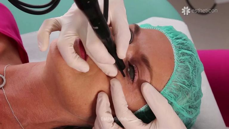 Jak probíhá laserové odstranění kožních výrůstků na očním víčku?