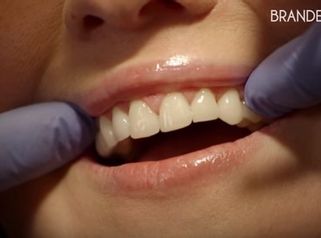 Estetická úprava zubů | Brandeis Clinic