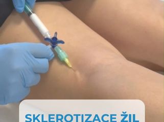 Sklerotiztace žil