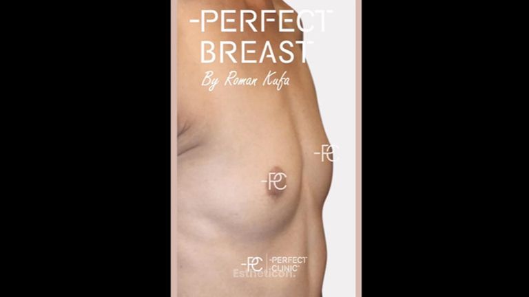 Zvětšení prsou - Perfect Clinic - centrum estetické medicíny