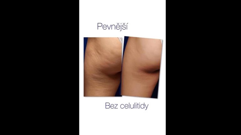 Celulitida - Klinika Laser Esthetic
