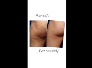 Celulitida - Klinika Laser Esthetic