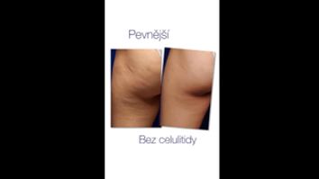 Celulitida - Klinika Laser Esthetic