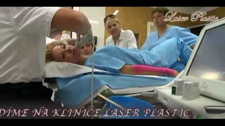 ULTHERAPIE na klinice Laser Plastic