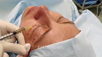 Rejuvenace očního okolí vlastní krevní plazmou