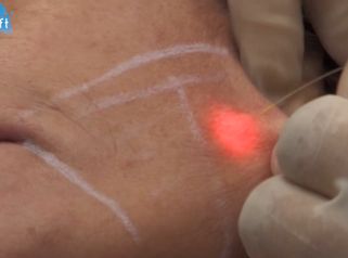 ENDOLIFT® je miniivazivní metoda omlazení obličeje
