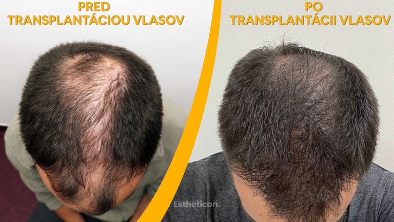 Transplantace vlasů - PHAEYDE Clinic