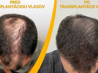Transplantace vlasů - PHAEYDE Clinic