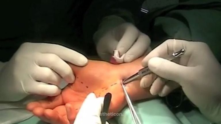Endoskopická operace syndromu karpálního tunelu