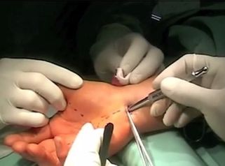 Endoskopická operace syndromu karpálního tunelu