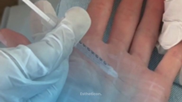 Odstranění pocení