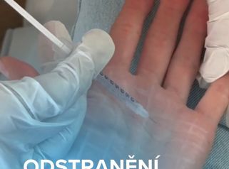 Odstranění pocení