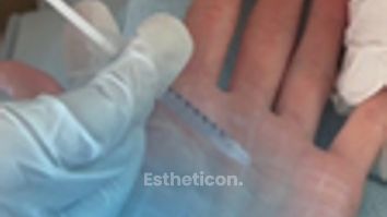 Odstranění pocení