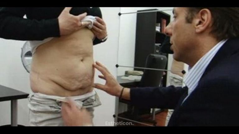 Video konzultace - Abdominoplastika